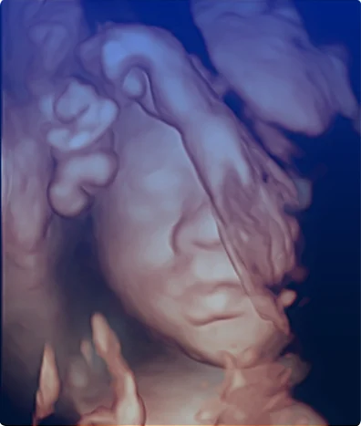 ULTRASONIDO OBSTETRICO TRANSNUCAL